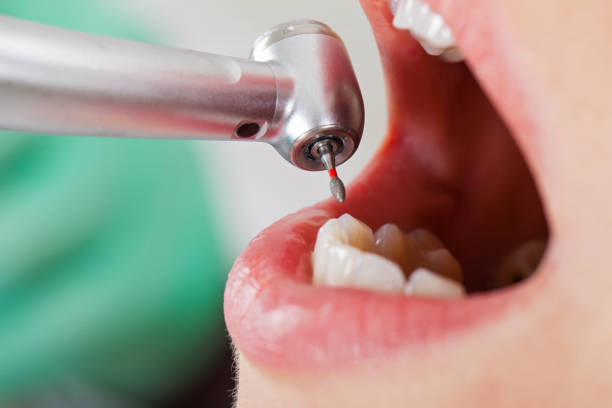 Best Emergency Broken Tooth Repair in University Heights, IA